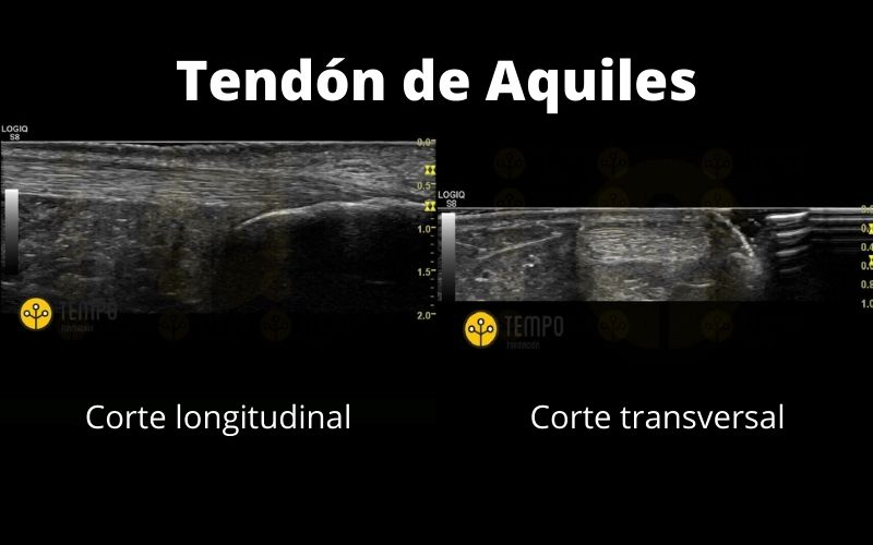 Tend n De Aquiles Aprende A Valorarlo Ecograf a Tempo Formaci n tend-n-de-aquiles-aprende-a-valorarlo-ecograf-a-tempo-formaci-n